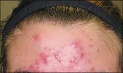 Acne Infested My VANEty*: A little schooling on AcNe!