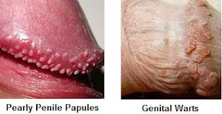 Genital Papules in an Adult Male - aafp.org