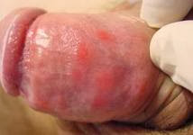 Obat Sipilis Yang Murah -
