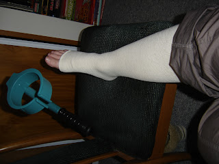 My right leg encased in a pressure bandage from toe to thigh, immobilized, with crutches poised and ready
