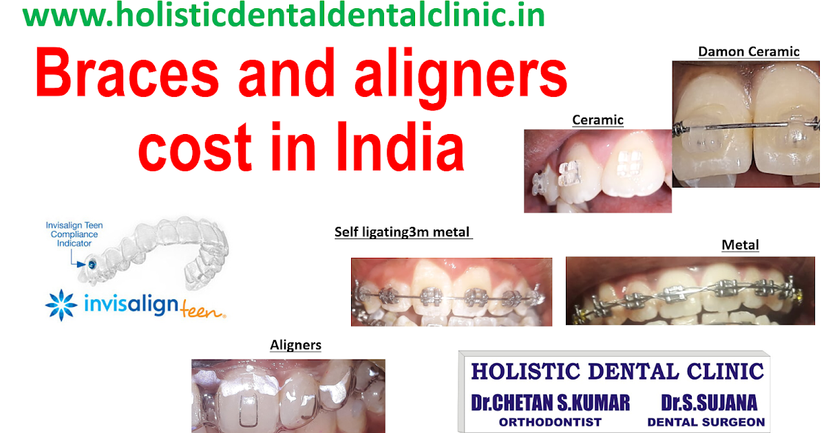 Braces and Aligners cost in India