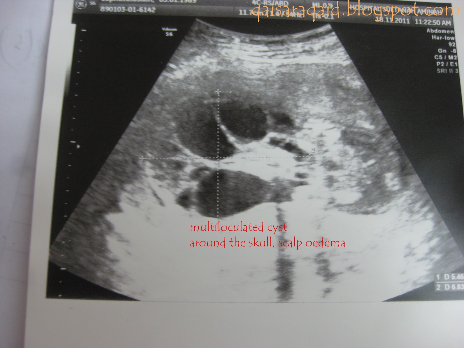 DIARI MAMA Hydrops Fetalis 2