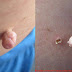 Granny Remedies for Removing Skin Tags Permanently
