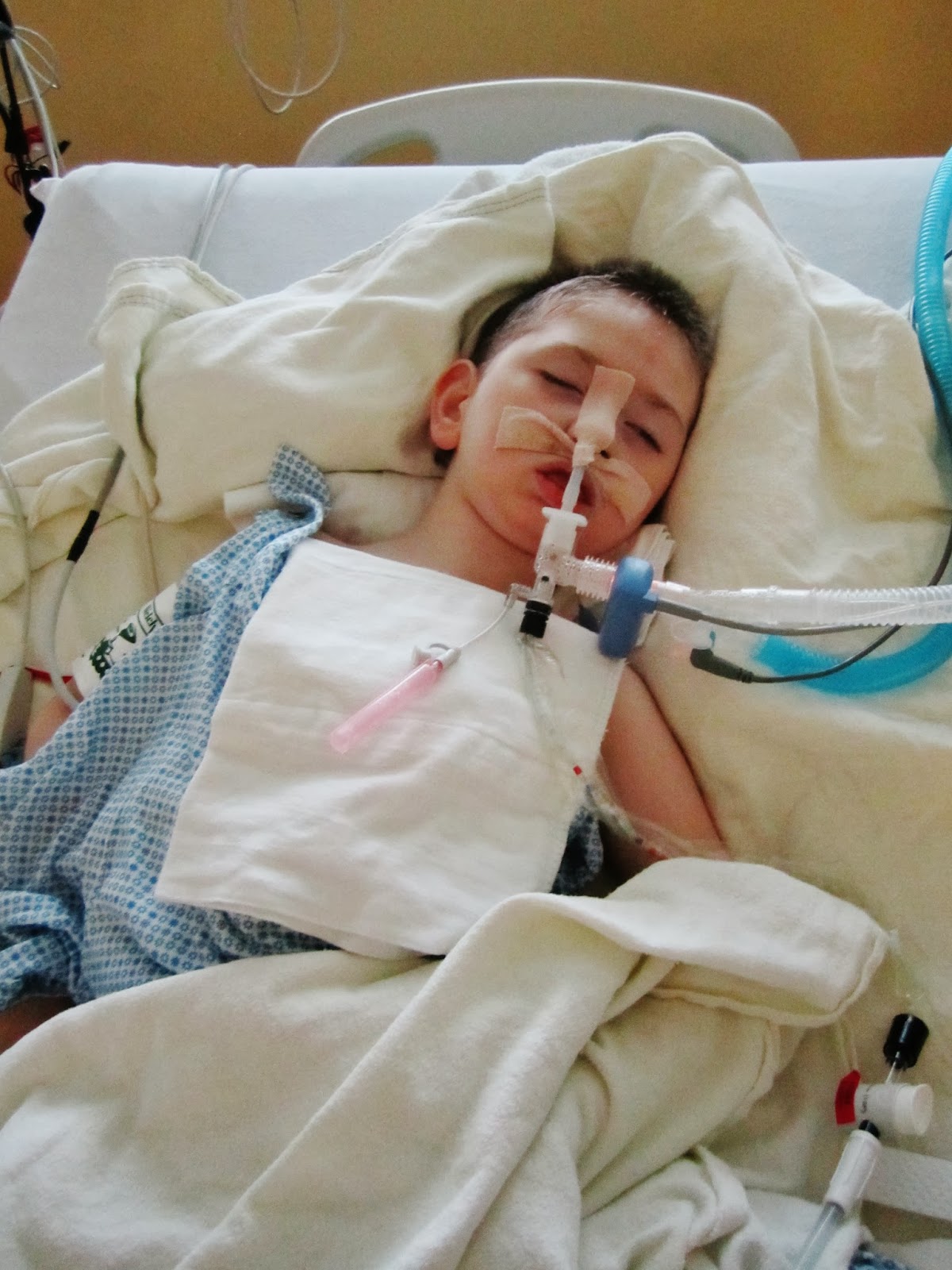 Behind Blue Eyes.... tongue reduction surgery.