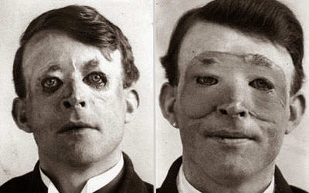 40 Must-See Photos Of The Past - Walter Yeo, one of the first to undergo an advanced plastic surgery and a skin transplant, 1917