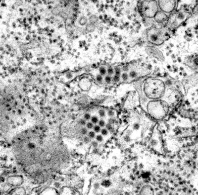 maladies contagieuses maladies contagieuses