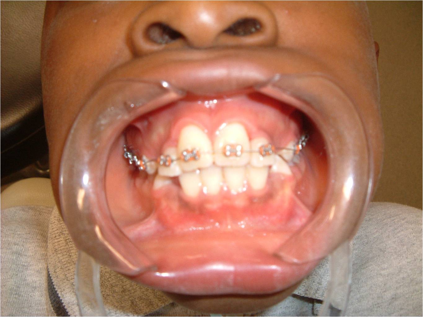 Affordable Braces in Lagos