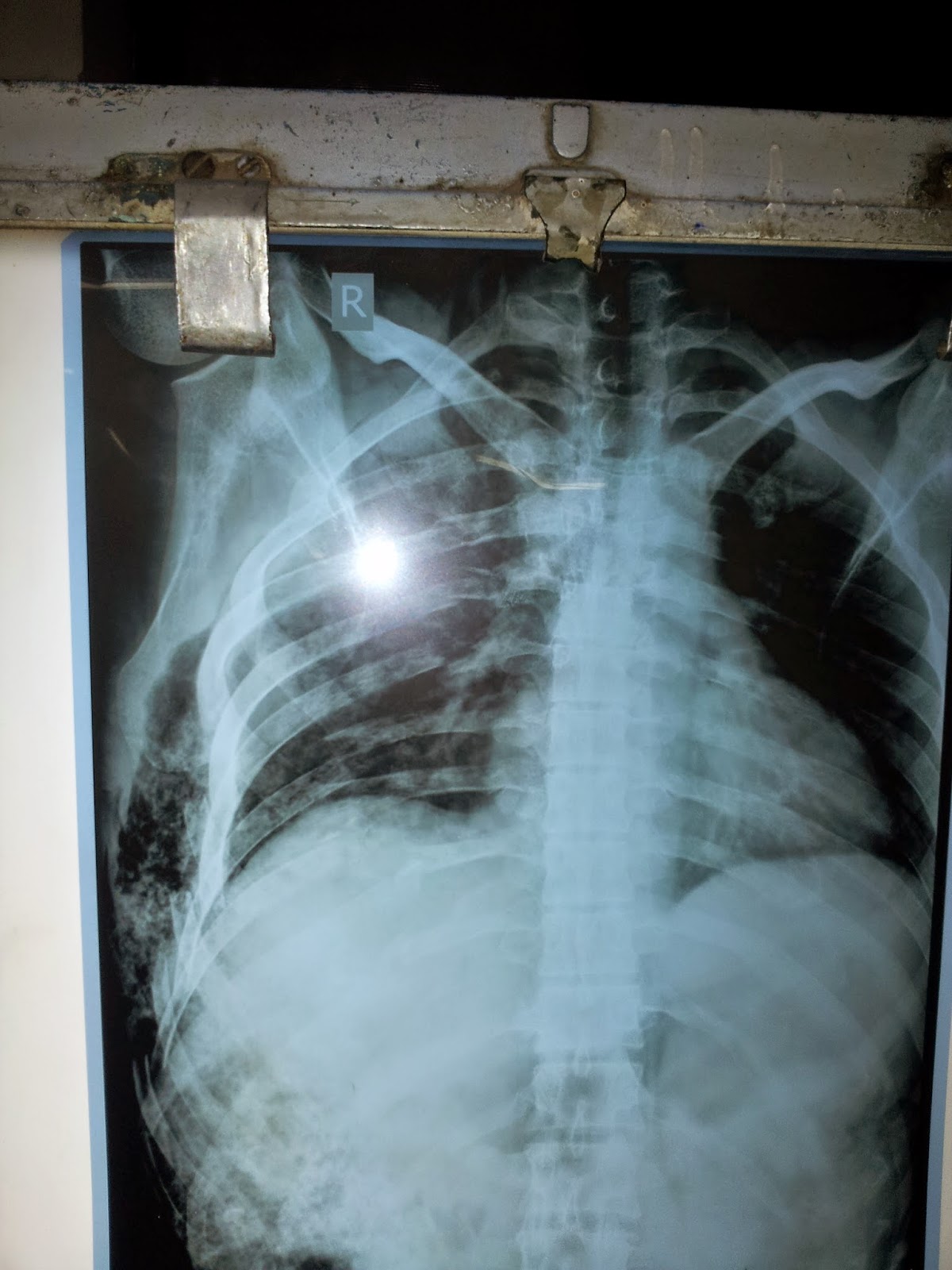 General Surgery Clinics A Surgeon's Blog Surgical Emphysema