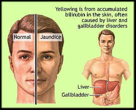 Adult Jaundice 107