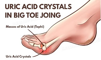 Apa Ubat Gout Paling Mujarab Pengedar Shaklee Malaysia