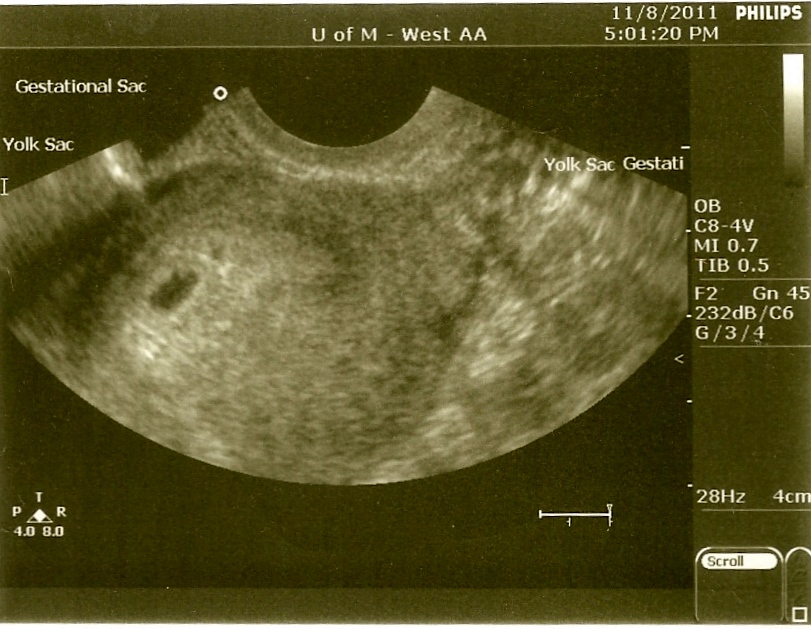 Bump On The Hill Ultrasound and Heartbeat!