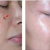Here's How That Spots On Your Face Appear? And How To Treat It