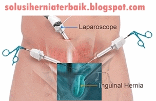 Pengobatan Hernia dan Cara Ampuh Tangani Hernia Pengobatan Hernia dan Cara Ampuh Tangani Hernia