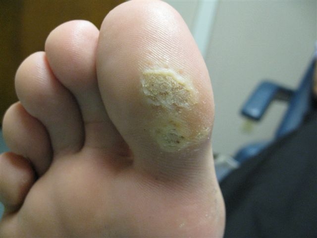 Plantar Wart Treatment, Home Remedies & Removal