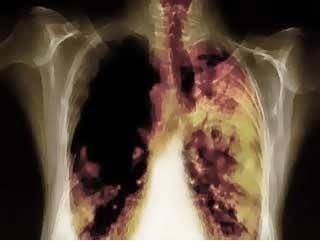 obat kanker Paru alami, obat kanker paru, pengobatan kanker paru