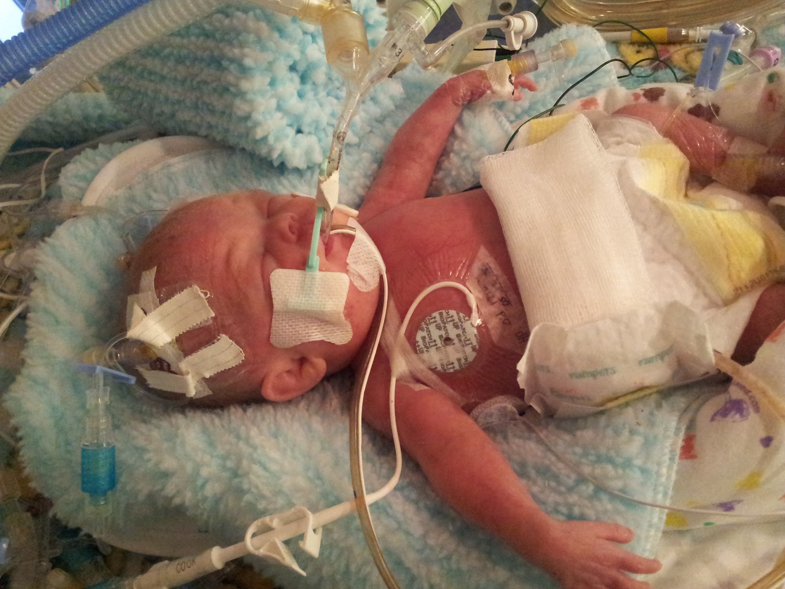 A Three E Circus Baby Eagan NICU Day 34 Good News a-three-e-circus-baby-eagan-nicu-day-34-good-news