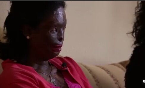 Photos: Community rally behind Ethiopian woman disfigured, blinded by acid attack by her abusive husband after she asked for a divorce