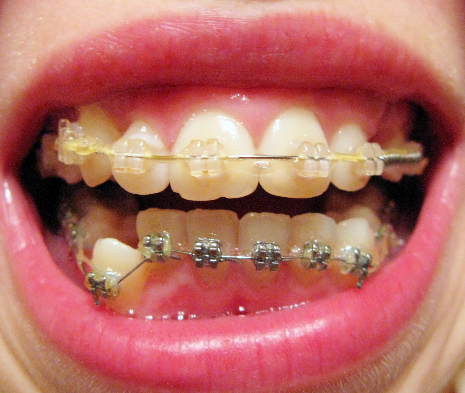 Сколько стоят брекеты на зубы цена. Металлические брекеты. Металлические брекеты на зубах.