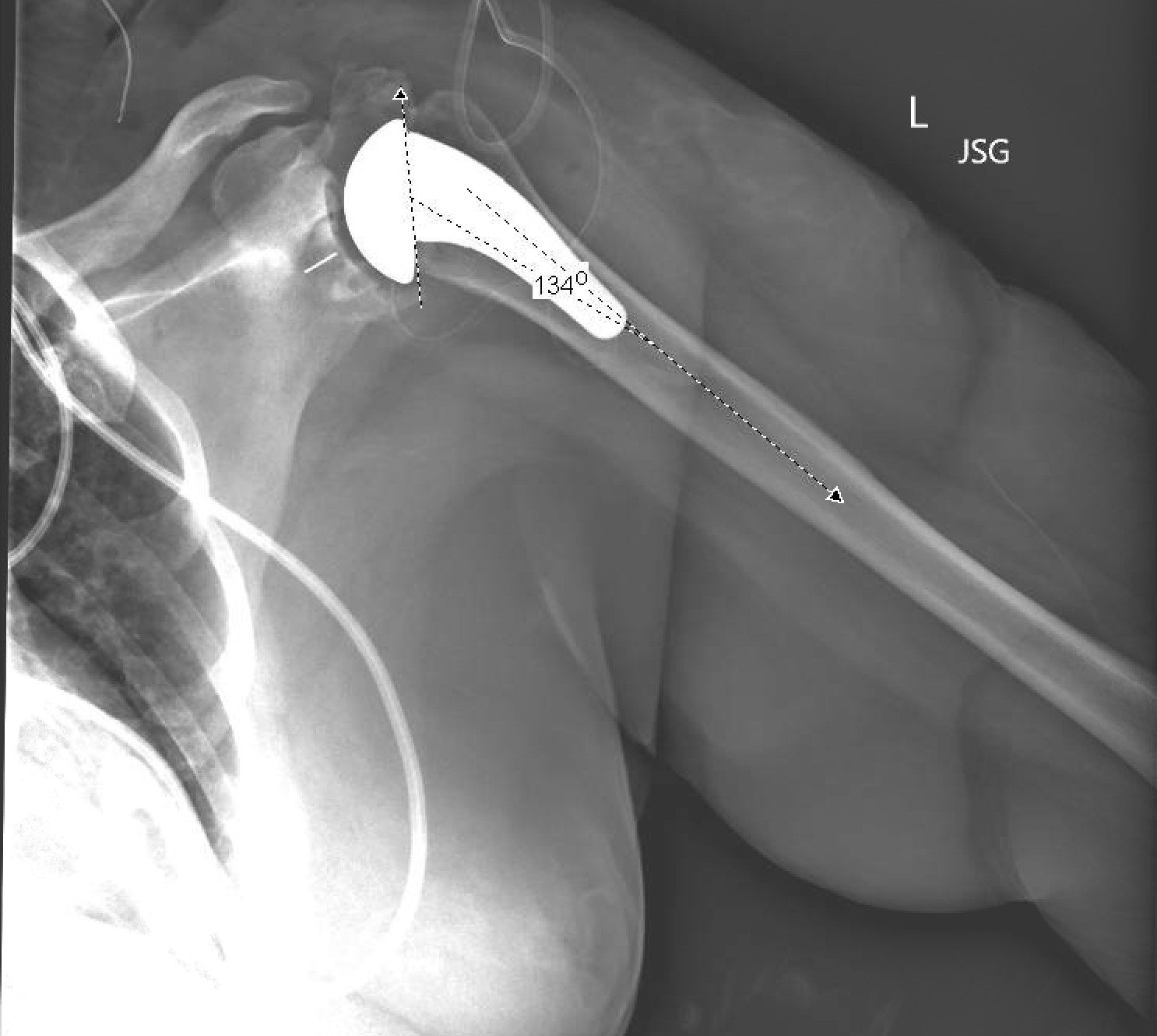 Shoulder and Elbow Surgery Does a stemless shoulder arthroplasty offer