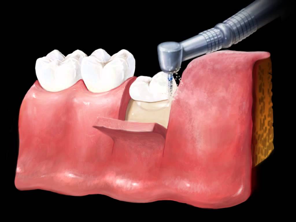ORAL SURGERY Complications after extraction of impacted third molars