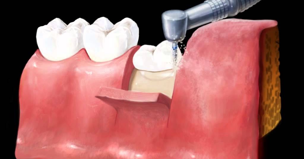 ORAL SURGERY Complications after extraction of impacted third molars