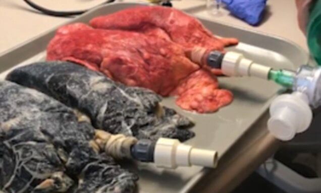 Terrifying Video Compares The Lungs of A Smoker And A Non-Smoker