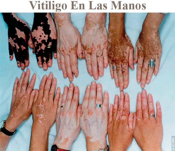 Vitiligo en manos