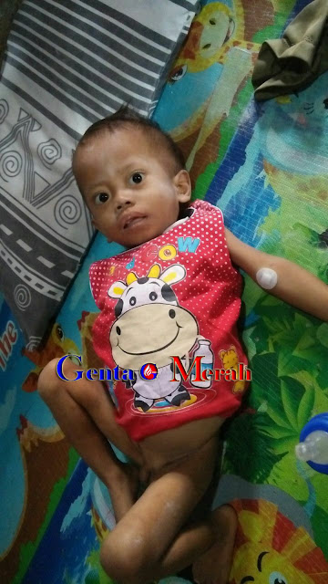 Bocah 3,5 Tahun Telah Yatim Piatu di Lamteng Alami Gizbur, Butuh Uluran Tangan Donatur