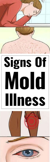 17 Signs of Mold Illness (and How to Tell If You Are at Risk)