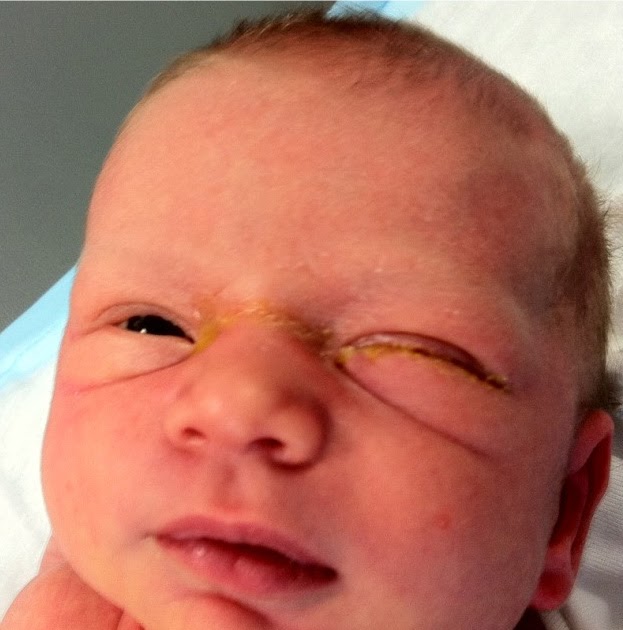 Symptoms Of A Blocked Tear Duct In Babies Baby Viewer