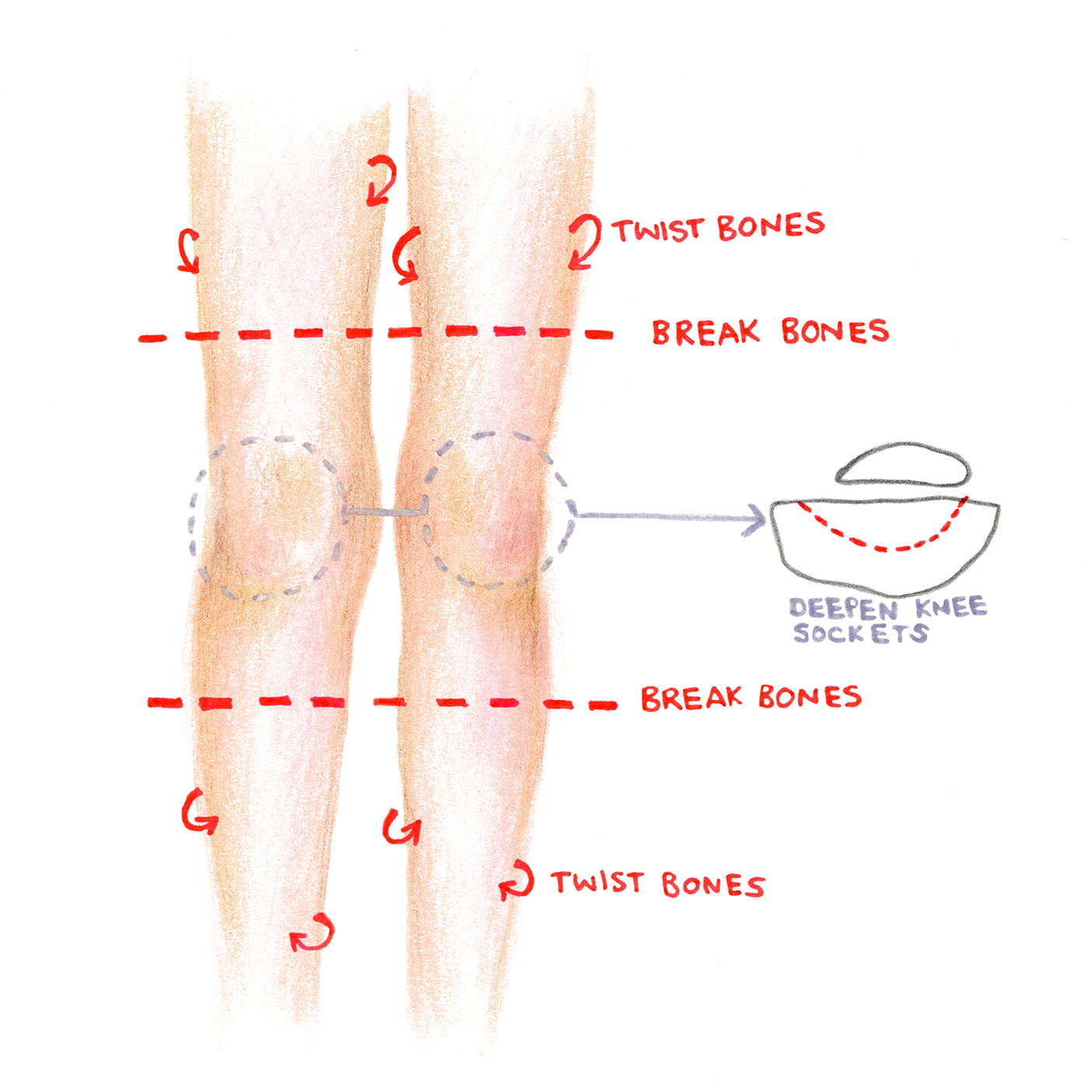 floating knees The Story of my Floating Knees A New Year Update
