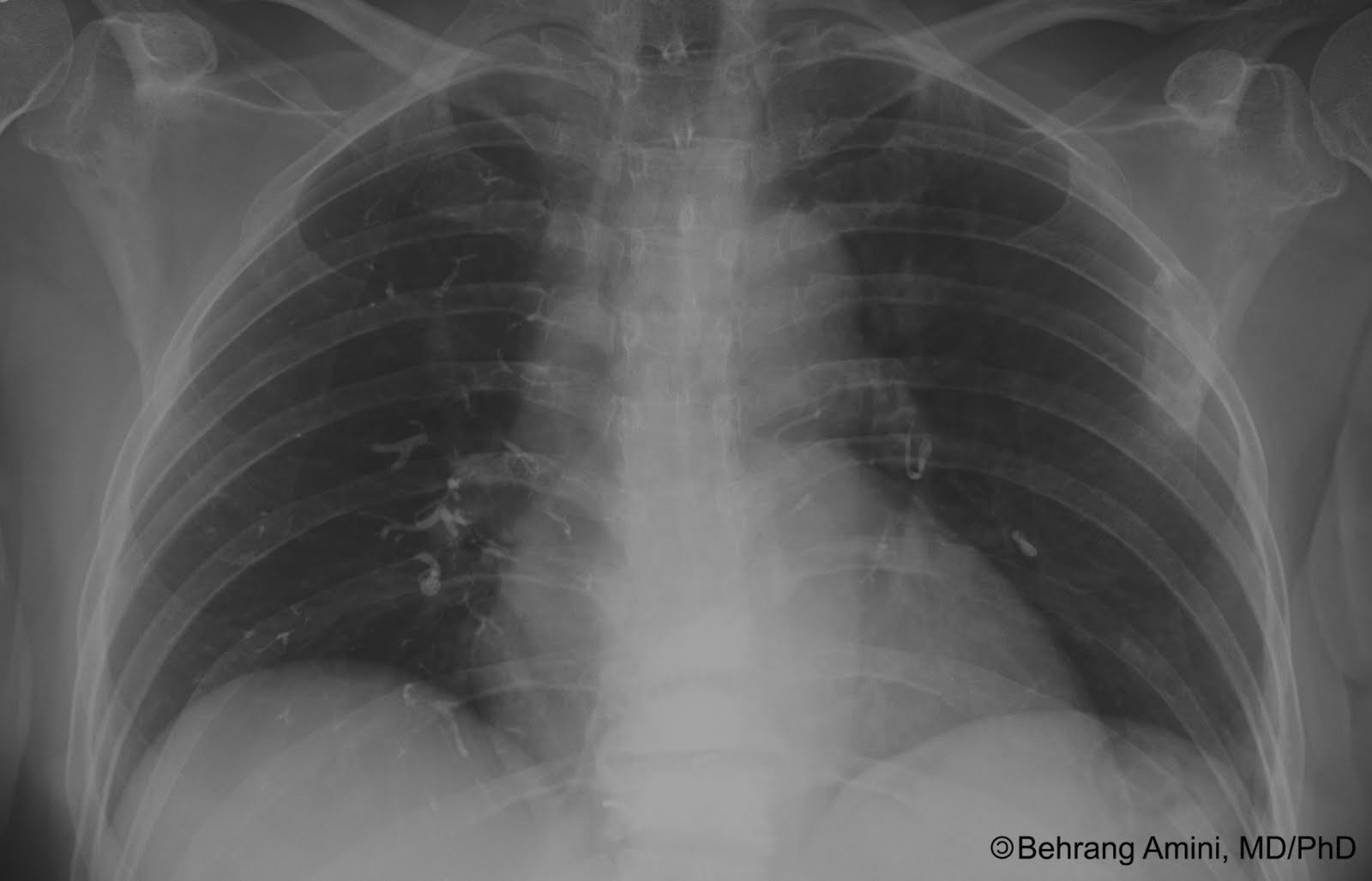 roentgen ray reader cement embolism roentgen ray reader cement embolism
