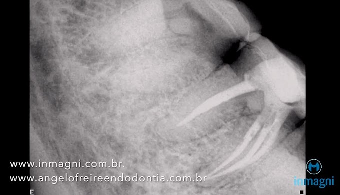 ENDODONTIA de molar com tratamento do canal mésio central e obturação com biocerâmico