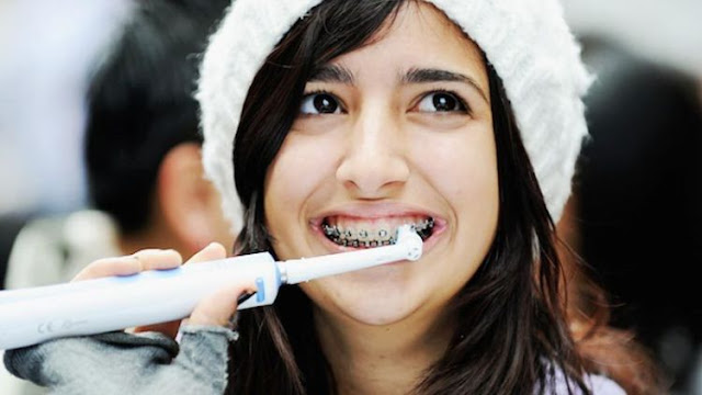 Ingin Pasang Kawat Gigi? Eits Jangan Buru-buru, Pikirkan 8 Hal Ini