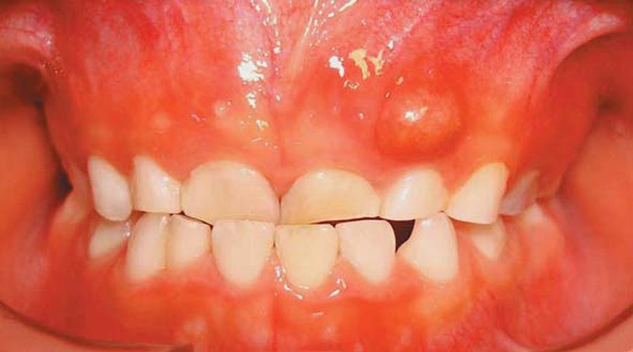 ¿QUÉ ES UNA FISTULA INTRAORAL? 🦷Con Dientes Salud Bucal