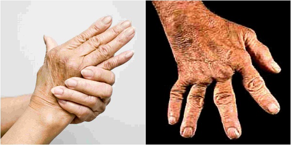 Remedios naturales para la artritis reumatoide en las manos