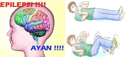 Obat-Penyakit-Ayan-Epilepsi.jpg