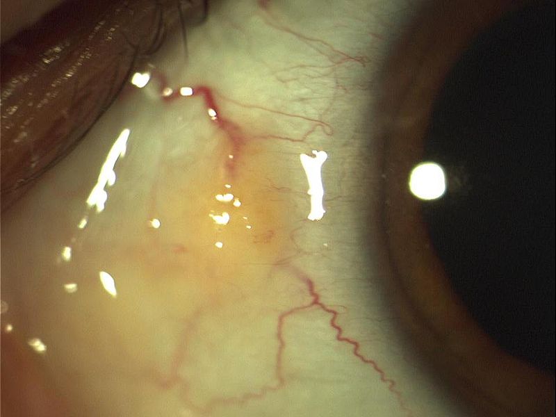 EyeFacts – by Dr. Brad Wicklund