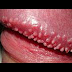 Penularan Penyakit Kondiloma thumbnail