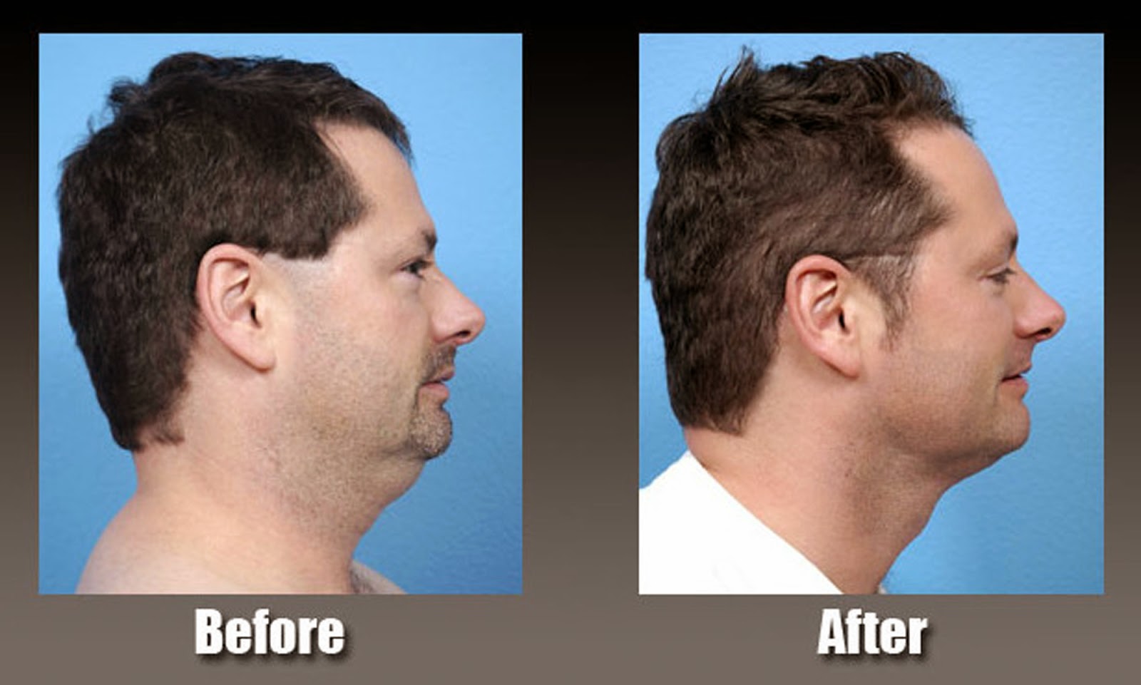 Liposuction Las Vegas