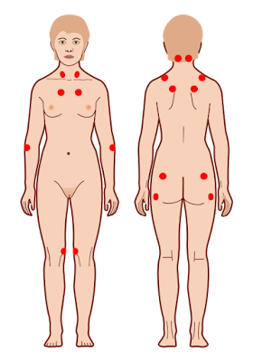 tender point symptoms in Fibromyalgia