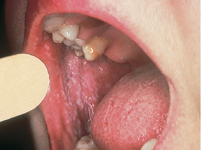 Lichen planus of the oral mucosa