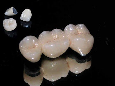 Răng sứ có ưu và nhược điểm gì?