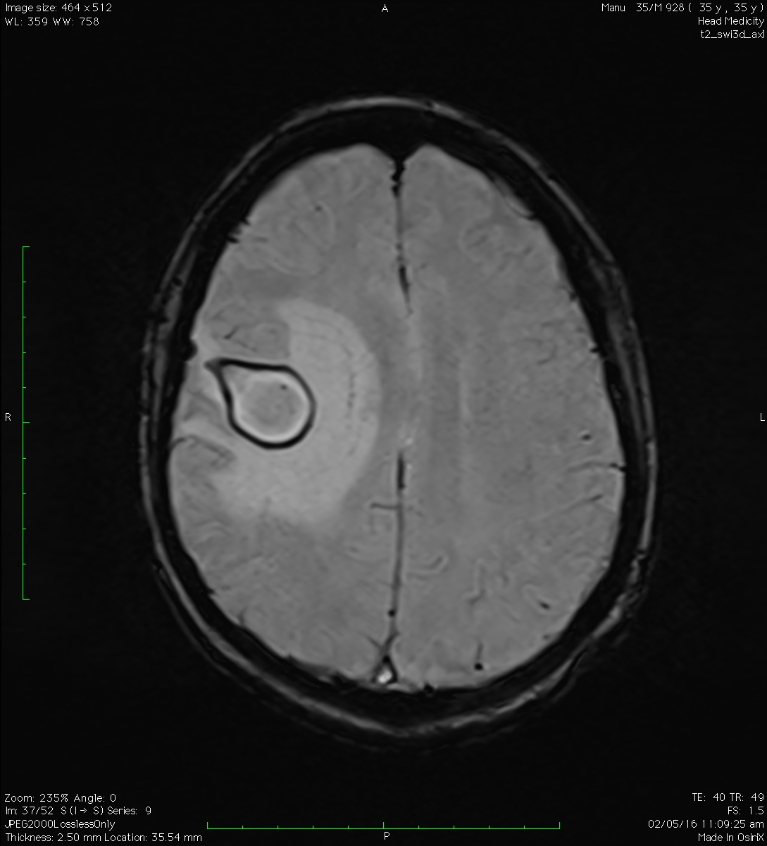 Brain abscess - Pictures