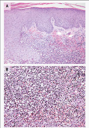 Epidermólisis ampollosa adquirida emedicina hipertensión Epidermólisis ampollosa adquirida emedicina hipertensión