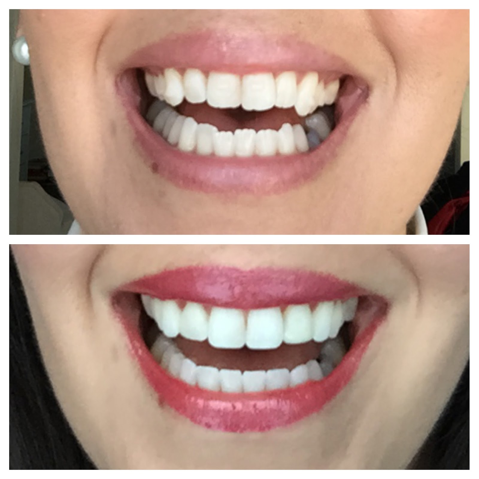 Crafty Teacher Lady The Invisalign Experience