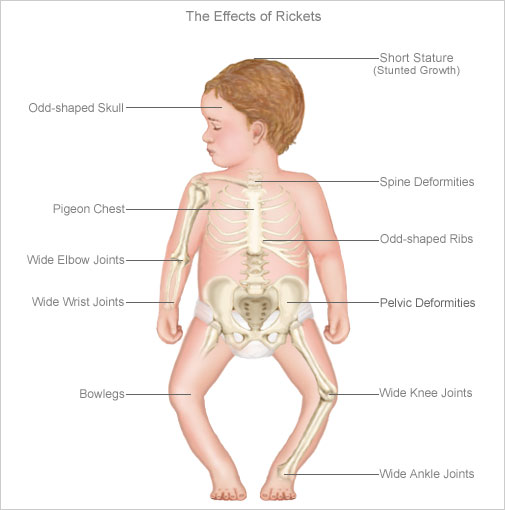 Rickets Graph Rickets: A Case of Vitamin D Deficiency : 2015