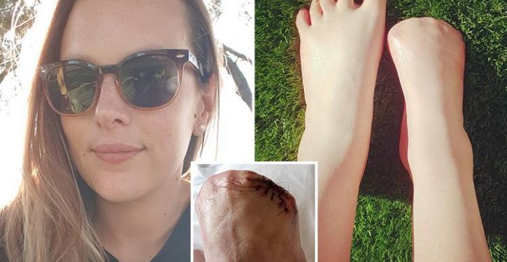 Woman Has Five Toes Amputated After Being Infected In A Fish Pedicure