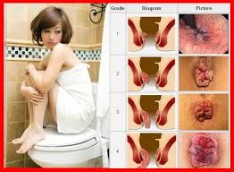 Foto Jual Obat Alternatif Wasir Murah Bukan Murahan