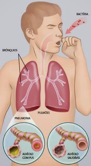 Acupuntura X Pneumonia